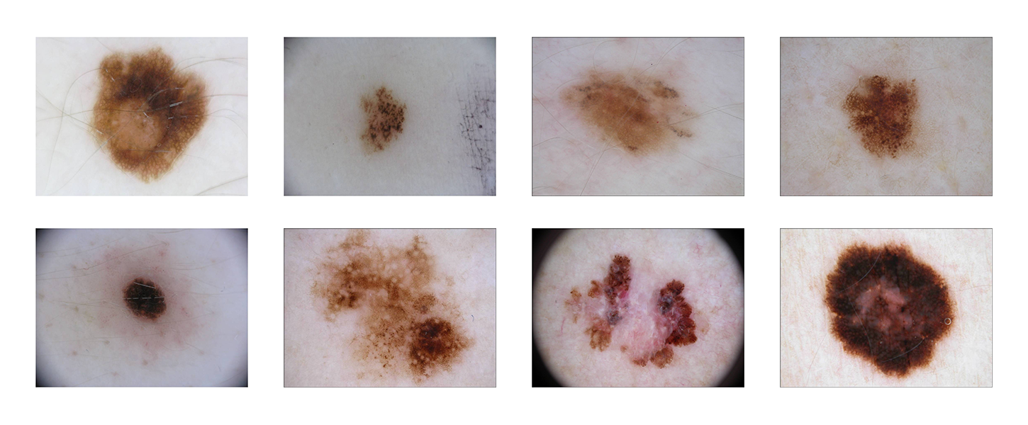 ensembles with crowdsourced features improve skin lesion
