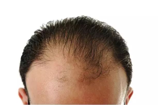 男性秃顶原因到底是什么？这几个因素缺一不可！脱发有可能是什么病引起的