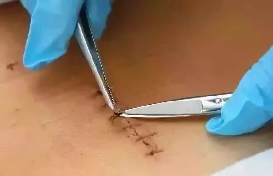 皮肤拉链问世告别缝针与疤痕终结万人之痛