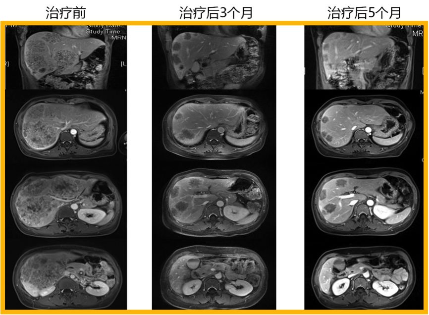 肺鳞癌1期a手术后要放疗吗_乳腺癌化疗后要放疗吗_肠癌放疗一次要多少钱